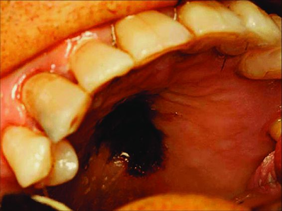 Close-up of the Upper Teeth and Palate Inside the Mouth, Showing Inflamed Gums and a Dark Irregular Patch on the Palate Near the Back.