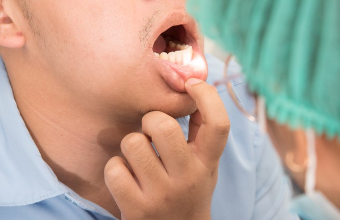 HPV Sore – CareQuest Institute Dental Professional Examines a Patient's Open Mouth, Lifting the Lip to View the Front Teeth.