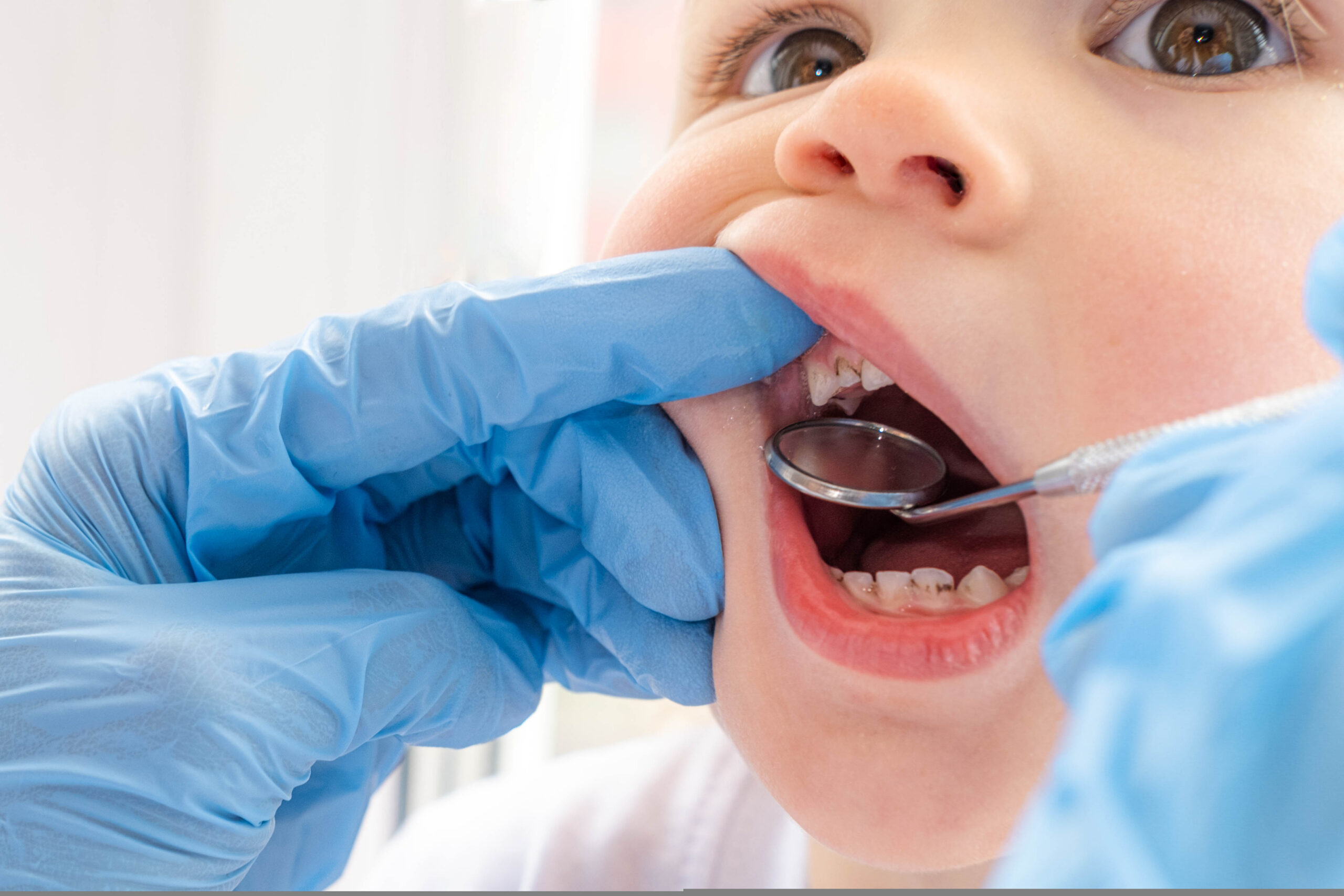 Pediatric Dental Exam: Gloved Hand Opens the Child’s Mouth with a Dental Tool Visible Inside the Mouth.